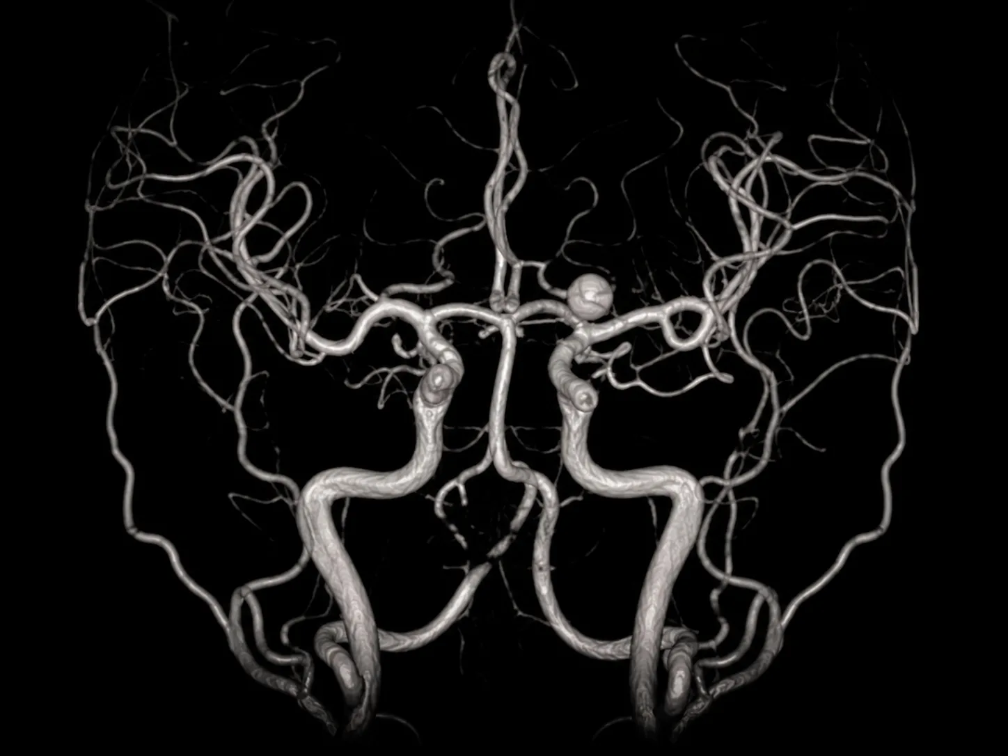 Tratamiento de aneurismas cerebrales en CDMX