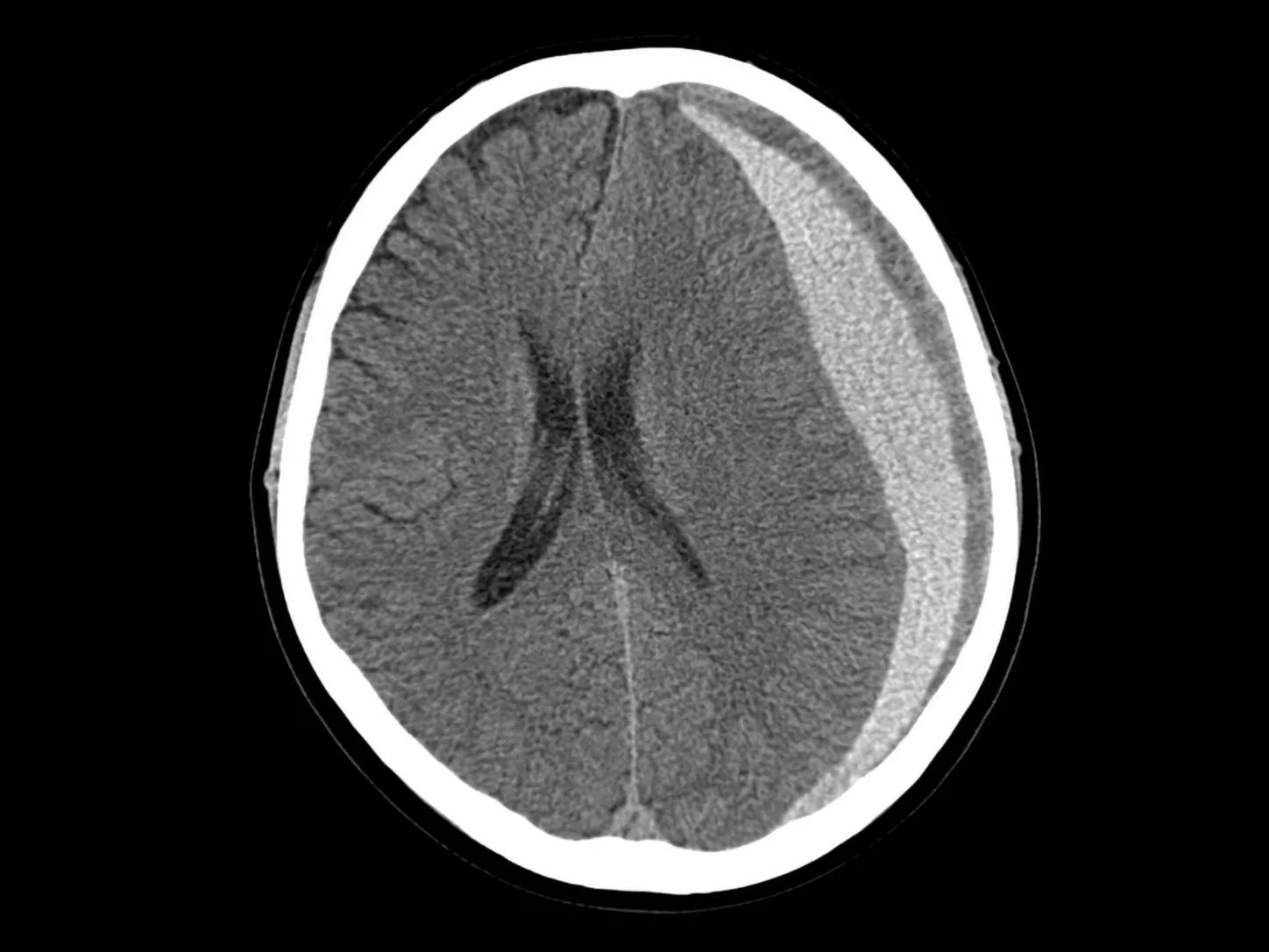Tratamiento de hematoma subdural en CDMX