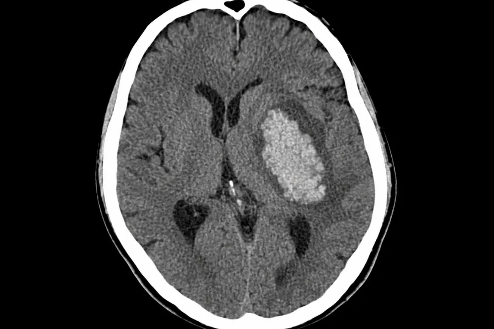 Tratamiento de hemorragias cerebrales en CDMX