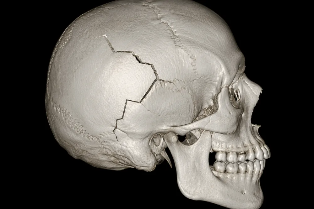 Tratamiento de trauma craneoencefálico en CDMX